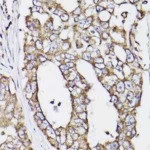 Immunohistochemistry analysis of paraffin-embedded human lung cancer using Anti-P4HB Antibody (A8454) at a dilution of 1:100 (40x lens). Perform high pressure antigen retrieval with 10 mM citrate buffer pH 6.0 before commencing with IHC staining protocol