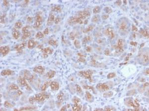 Immunohistochemical analysis of formalin-fixed, paraffin-embedded human breast carcinoma using Anti-Golgi Complex Antibody [GLG1/2829R]