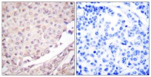 Immunohistochemical analysis of paraffin-embedded human lung carcinoma tissue using Anti-Cullin 1 Antibody. The right hand panel represents a negative control, where the Antibody was pre-incubated with the immunising peptide