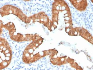 Immunohistochemical analysis of formalin-fixed, paraffin-embedded human colon adenocarcinoma using Anti-Villin Antibody [VIL1/4107R]