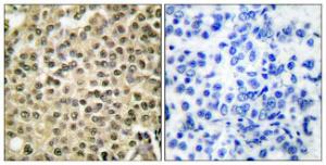 Immunohistochemical analysis of paraffin-embedded human breast carcinoma tissue using Anti-RAN Antibody. The right hand panel represents a negative control, where the antibody was pre-incubated with the immunising peptide