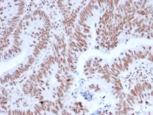 Immunohistochemical analysis of formalin-fixed, paraffin-embedded human colon carcinoma using Anti-NRF1 Antibody [NRF1/2608]