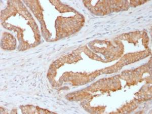 Immunohistochemical analysis of formalin-fixed, paraffin-embedded human prostate carcinoma using Anti-Ezrin Antibody [CPTC-Ezrin-1]