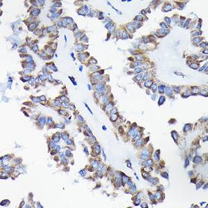 Immunohistochemistry analysis of paraffin-embedded human thyroid cancer using Anti-AIF Antibody (A8473) at a dilution of 1:50 (40X lens). Perform high pressure antigen retrieval with 10 mM citrate buffer pH 6.0 before commencing with IHC staining protocol