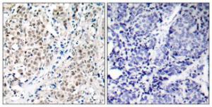 Immunohistochemical analysis of paraffin-embedded human breast carcinoma tissue using Anti-MYC Antibody The right hand panel represents a negative control, where the antibody was pre-incubated with the immunising peptide