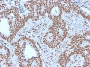 Immunohistochemical analysis of formalin-fixed, paraffin-embedded human colon carcinoma using Anti-NRF1 Antibody [NRF1/2609]