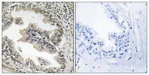 Immunohistochemical analysis of paraffin-embedded human prostate carcinoma tissue using Anti-SH3GLB2 Antibody. The right hand panel represents a negative control, where the antibody was pre-incubated with the immunising peptide