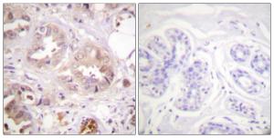 Immunohistochemical analysis of paraffin-embedded human breast carcinoma tissue using Anti-CDK7 Antibody. The right hand panel represents a negative control, where the antibody was pre-incubated with the immunising peptide