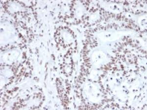 Immunohistochemical analysis of formalin-fixed, paraffin-embedded human prostate carcinoma using Anti-NRF1 Antibody [NRF1/2609]