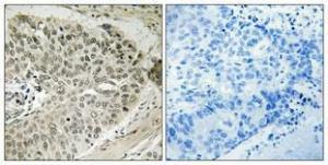 Immunohistochemical analysis of paraffin-embedded human lung cancer using Anti-CDK7 Antibody 1:100 (4 °C overnight). The right hand panel represents a negative control, where the antibody was pre-incubated with the immunising peptide