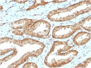 Immunohistochemical analysis of formalin-fixed, paraffin-embedded human prostate carcinoma using Anti-YB1 Antibody [YBX1/2430]