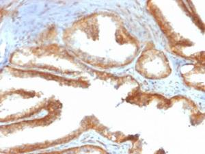 Immunohistochemical analysis of formalin-fixed, paraffin-embedded human prostate carcinoma using Anti-YB1 Antibody [rYBX1/2430]