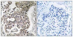 Immunohistochemical analysis of paraffin-embedded human breast carcinoma tissue using Anti-PPP2R1B Antibody. The right hand panel represents a negative control, where the antibody was pre-incubated with the immunising peptide