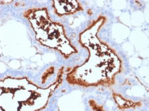 Immunohistochemical analysis of formalin-fixed, paraffin-embedded human lung carcinoma using Anti-CD73 Antibody [NT5E/2503]