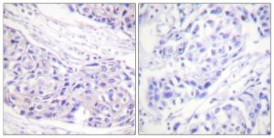 Immunohistochemical analysis of paraffin-embedded human breast carcinoma tissue using Anti-p90 RSK Antibody. The right hand panel represents a negative control, where the antibody was pre-incubated with the immunising peptide.