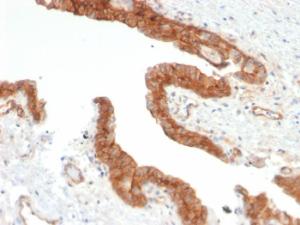 Immunohistochemical analysis of formalin-fixed, paraffin-embedded human prostate carcinoma using Anti-CD73 Antibody [NT5E/2503]