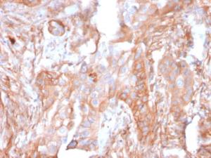 Immunohistochemical analysis of formalin-fixed, paraffin-embedded human colon carcinoma using Anti-CD73 Antibody [NT5E/2503]