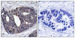 Immunohistochemical analysis of paraffin-embedded human breast carcinoma tissue using Anti-p62 Dok Antibody. The right hand panel represents a negative control, where the antibody was pre-incubated with the immunising peptide.