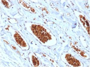 Immunohistochemical analysis of formalin-fixed, paraffin-embedded human angiosarcoma using Anti-Glycophorin A Antibody [rGYPA/280]