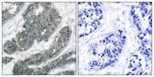 Immunohistochemical analysis of paraffin-embedded human breast carcinoma tissue using Anti-p62 Dok Antibody. The right hand panel represents a negative control, where the Antibody was pre-incubated with the immunising peptide