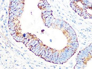 Immunohistochemistry analysis of paraffin-embedded human colon carcinoma tissue using Anti-PDHB Antibody [ARC1074] (A306144) at a dilution of 1:100 (40x lens). Perform microwave antigen retrieval with 10 mM PBS buffer pH 7.2 before commencing with IHC staining protocol.