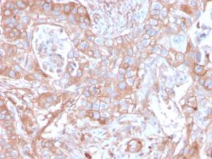 Immunohistochemical analysis of formalin-fixed, paraffin-embedded human colon carcinoma using Anti-CD73 Antibody [NT5E/2505]