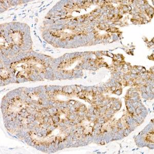 Immunohistochemistry analysis of paraffin-embedded human colon carcinoma tissue using Anti-NADH2 [9E12-1B3] Antibody (A92937) at a dilution of 1:50 (40x lens) Perform high pressure antigen retrieval with 10 mM citrate buffer pH 60 before commencing with IHC staining protocol