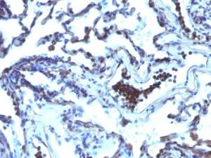 Immunohistochemical analysis of formalin-fixed, paraffin-embedded human lung carcinoma using Anti-TDP2 Antibody [TDP2/1258]