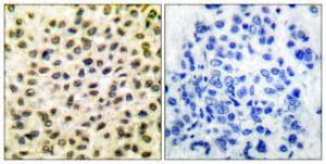 Immunohistochemical analysis of paraffin-embedded human breast carcinoma tissue using Anti-Fos Antibody. The right hand panel represents a negative control, where the antibody was pre-incubated with the immunising peptide