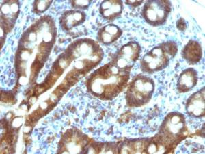 Immunohistochemical analysis of formalin-fixed, paraffin-embedded human duodenal carcinoma using Anti-TDP2 Antibody [TDP2/1258]