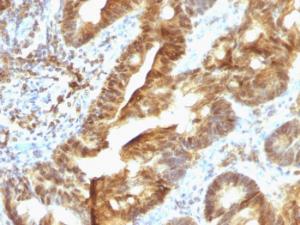 Immunohistochemical analysis of formalin-fixed, paraffin-embedded human colon carcinoma using Anti-TDP2 Antibody [TDP2/1258]