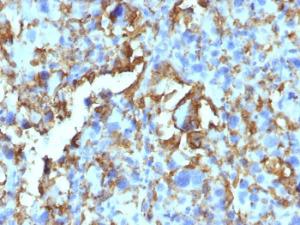 Immunohistochemical analysis of formalin-fixed, paraffin-embedded human histiocytoma using Anti-HLA DRB Antibody [LN-3 + HLA-DRB/1067]