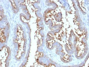 Immunohistochemical analysis of formalin-fixed, paraffin-embedded human prostate carcinoma using Anti-CD73 Antibody [NT5E/2545]