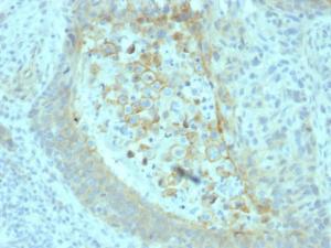 Immunohistochemical analysis of formalin-fixed, paraffin-embedded human pancreatic carcinoma using Anti-CD73 Antibody [NT5E/2545]