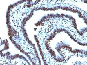 Immunohistochemical analysis of formalin-fixed, paraffin-embedded human ovarian carcinoma using Anti-Histone H1 Antibody [AE-4]