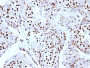 Immunohistochemical analysis of formalin-fixed, paraffin-embedded human testicular carcinoma using Anti-Histone H1 Antibody [AE-4]