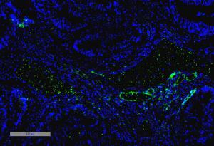 Immunohistochemistry analysis of human thyroid cancer