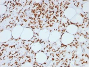 Immunohistochemical analysis of formalin-fixed, paraffin-embedded human angiosarcoma using Anti-Histone H1 Antibody [AE-4]