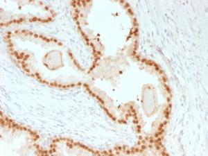 Immunohistochemical analysis of formalin-fixed, paraffin-embedded human prostate carcinoma using Anti-FOXA1 Antibody [rFOXA1/1515]