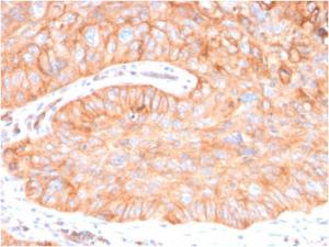 Immunohistochemical analysis of formalin-fixed, paraffin-embedded human colon carcinoma using Anti-CD73 Antibody [NT5E/2646]