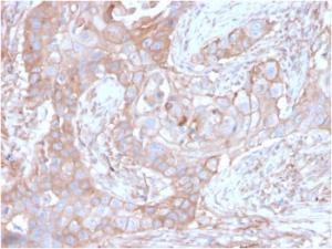 Immunohistochemical analysis of formalin-fixed, paraffin-embedded human colon carcinoma using Anti-CD73 Antibody [NT5E/2646]