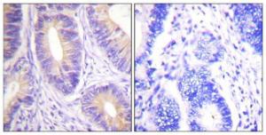 Immunohistochemical analysis of paraffin-embedded human colon carcinoma tissue using Anti-CBL Antibody. The right hand panel represents a negative control, where the antibody was pre-incubated with the immunising peptide.