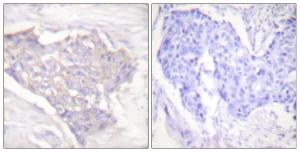 Immunohistochemical analysis of paraffin-embedded human breast carcinoma tissue using Anti-BIM Antibody. The right hand panel represents a negative control, where the antibody was pre-incubated with the immunising peptide.