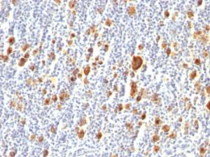 Immunohistochemical analysis of formalin-fixed, paraffin-embedded human Hodgkin's lymphoma using Anti-CD30 Antibody [Ber-H2]