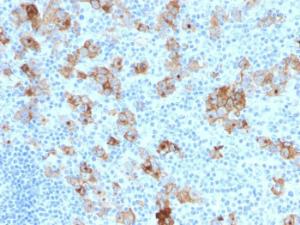 Immunohistochemical analysis of formalin-fixed, paraffin-embedded human Hodgkin's lymphoma using Anti-CD30 Antibody [SPM121]