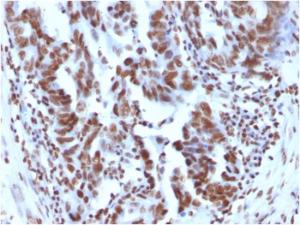 Immunohistochemical analysis of formalin-fixed, paraffin-embedded human ovarian carcinoma using Anti-Histone H1 Antibody [1415-1]