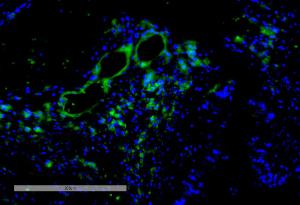 Immunohistochemistry analysis of human intestinal cancer