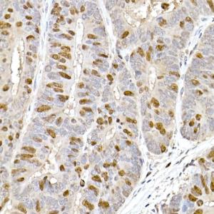 Immunohistochemistry analysis of paraffin-embedded human colon carcinoma tissue using Anti-TPX2 Antibody (A307828) at a dilution of 1:100 (40x lens). Perform high pressure antigen retrieval with 10 mM citrate buffer pH 6.0 before commencing with IHC staining protocol.