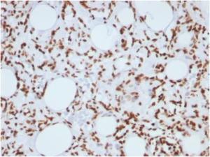 Immunohistochemical analysis of formalin-fixed, paraffin-embedded human angiosarcoma using Anti-Histone H1 Antibody [1415-1]