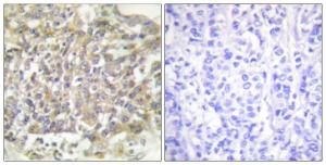 Immunohistochemical analysis of paraffin-embedded human breast carcinoma tissue using Anti-Shc Antibody The right hand panel represents a negative control, where the antibody was pre-incubated with the immunising peptide